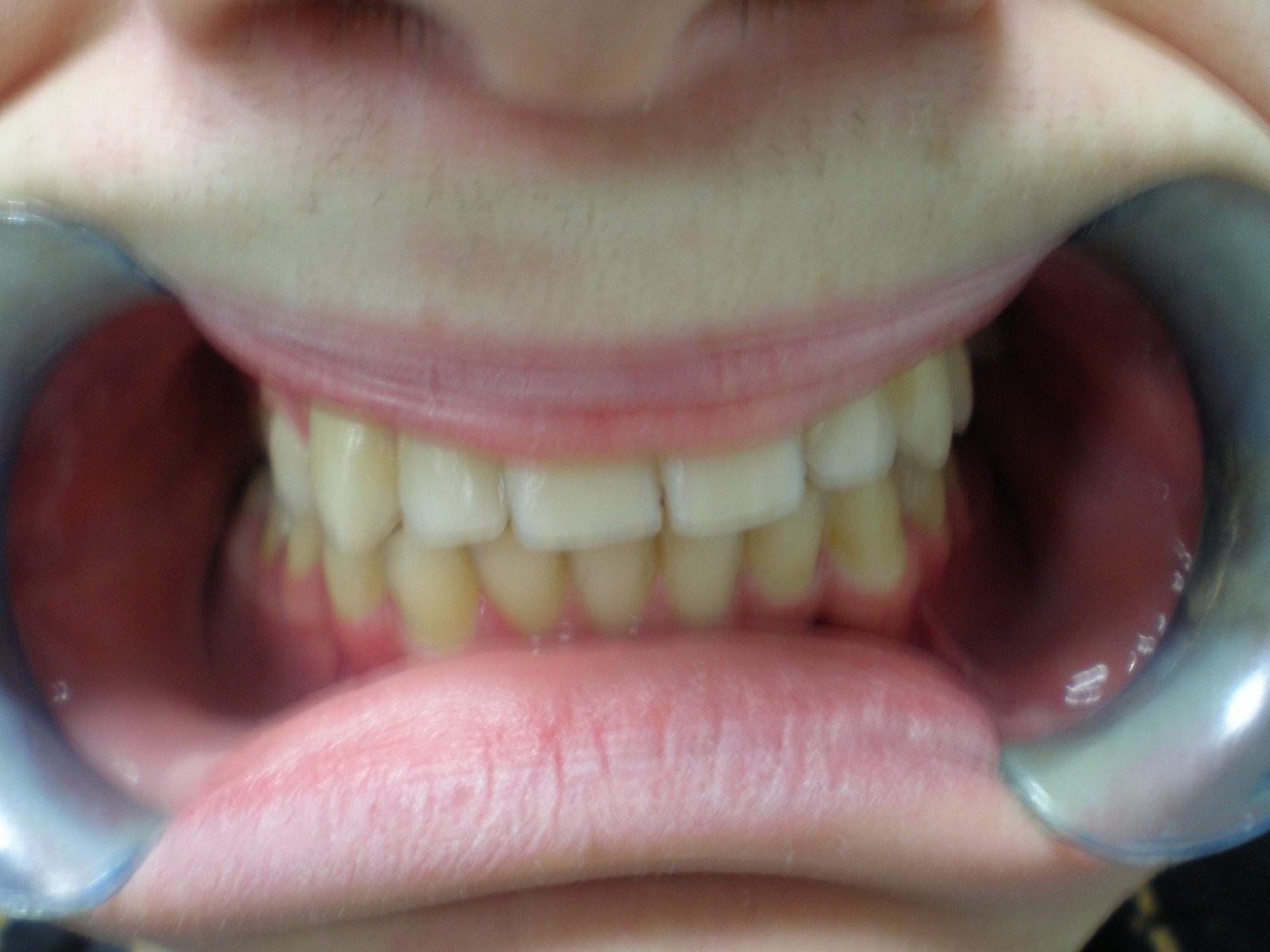 11-after