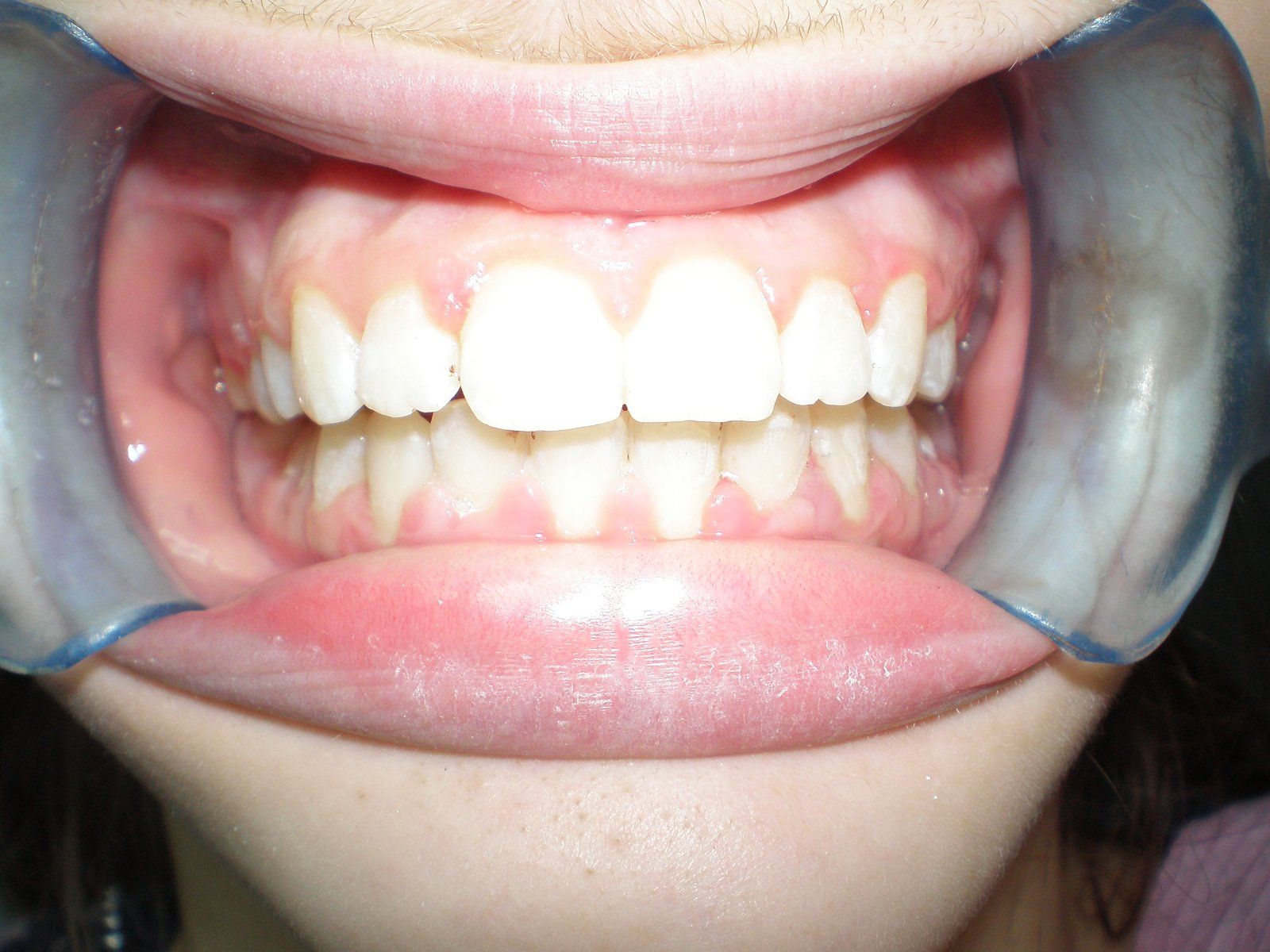 2-after