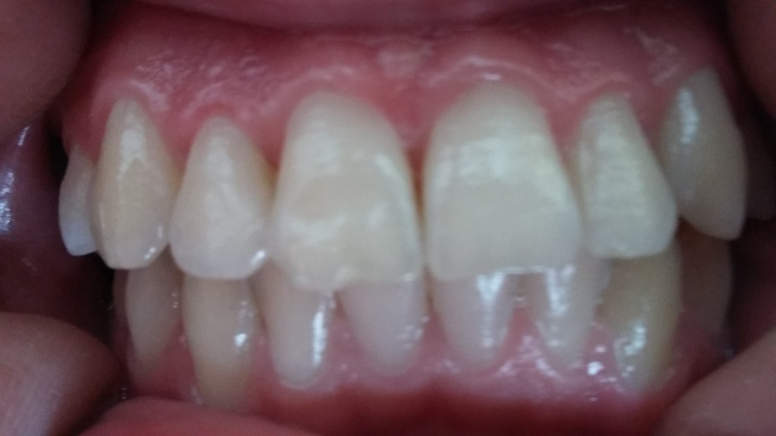 5-after