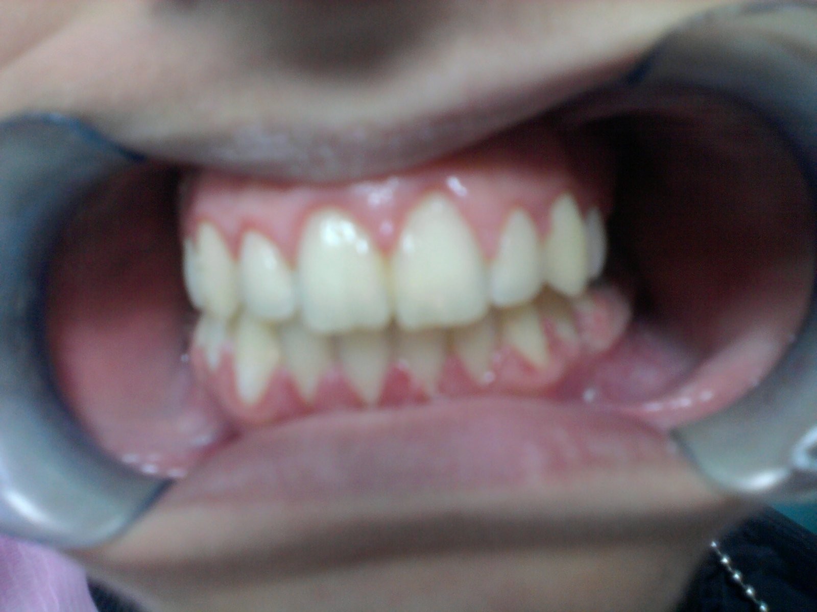 7-after